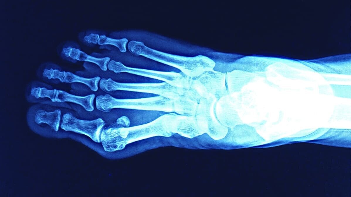 Ein Röntgenbild eines Fußes. 
